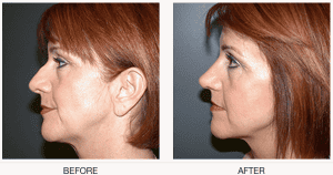 Rhinoplasty